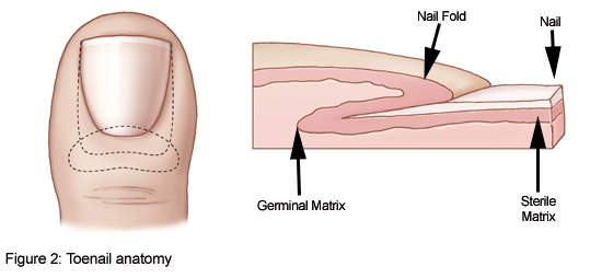 Ingrowing toenails and how to get rid of them permanently | Lindsey Ebbs  Podiatry