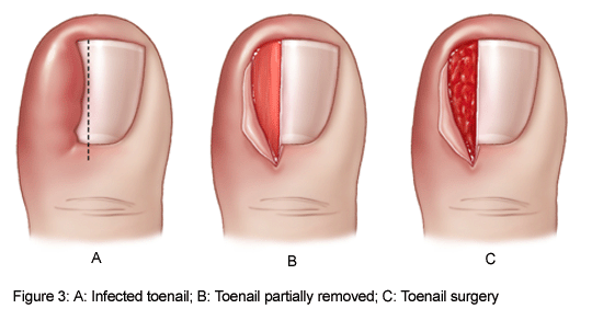 Nail Surgery | Chase Podiatry