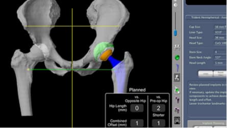 Robotic Assisted Hip Replacement