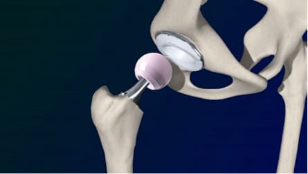 Robotic Assisted Hip Replacement