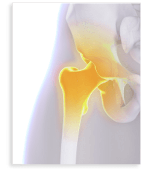 Robotic Assisted Hip Replacement