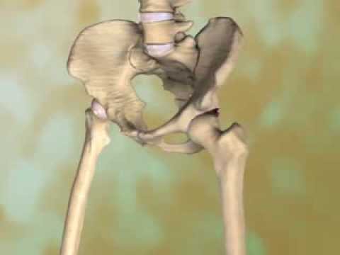 Osteoarthritis of the Hip