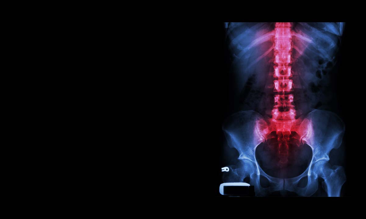 Scoliosis