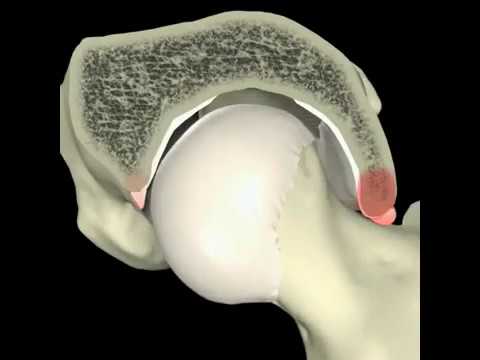 Demo Concept of Femoroacetabular Impingment (FAI) - Pincer