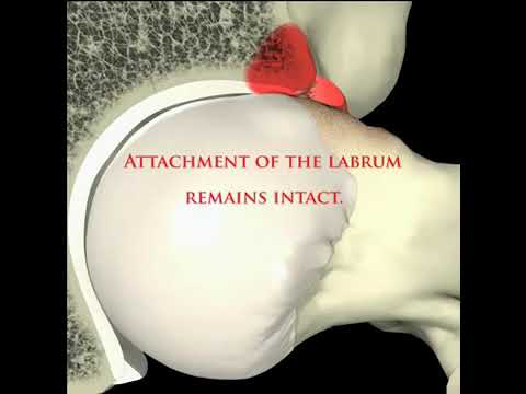 Demo Concept of Femoroacetabular Impingment (FAI) - CAM