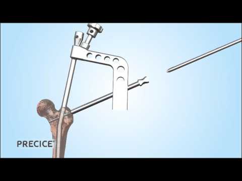 PRECICE Antegrade Femur Animation