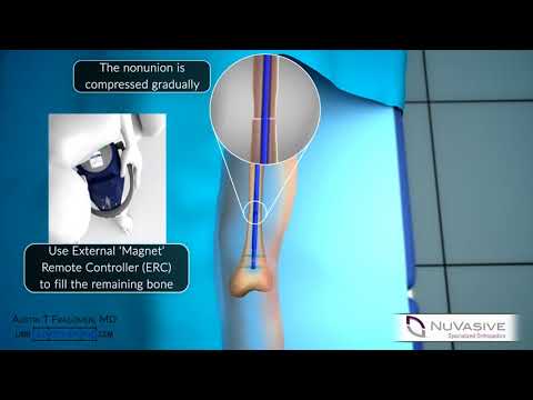 Managing Bone Defects with the PRECICE Intramedullary Compression Nail