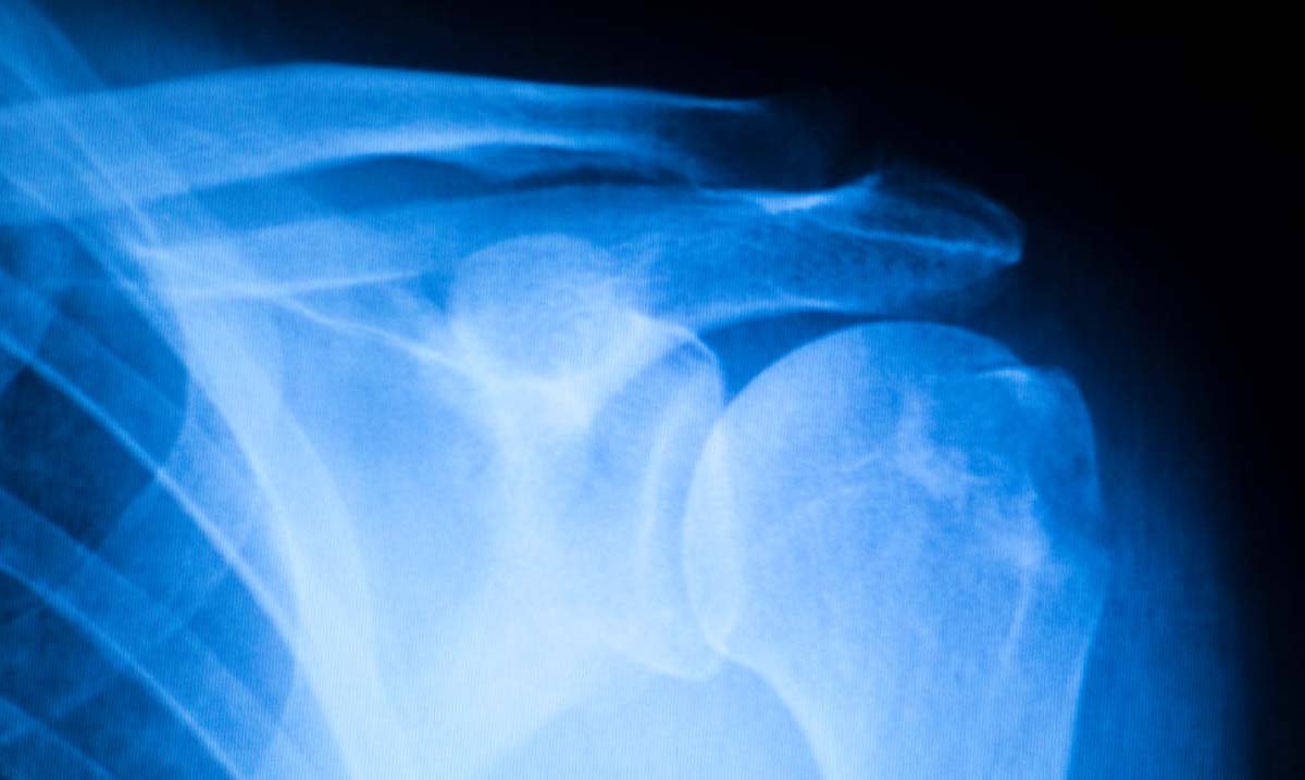 Shoulder